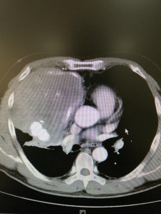 与胸壁,膈肌,肺上叶,心包粘连紧密,肿瘤较大几乎占据整个胸腔,操作